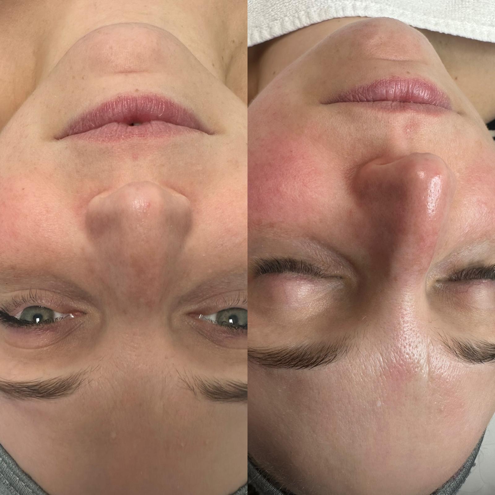 Facial treatment before and after